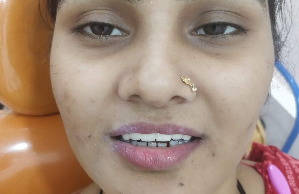 Clear aligner tray for invisible teeth straightening
